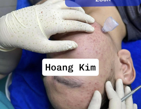 Tạm Biệt Nỗi Lo Về Mụn – Trải Nghiệm Liệu Trình Chăm Sóc Da Chuyên Sâu Chỉ 285K Tại Hoàng Kim Spa